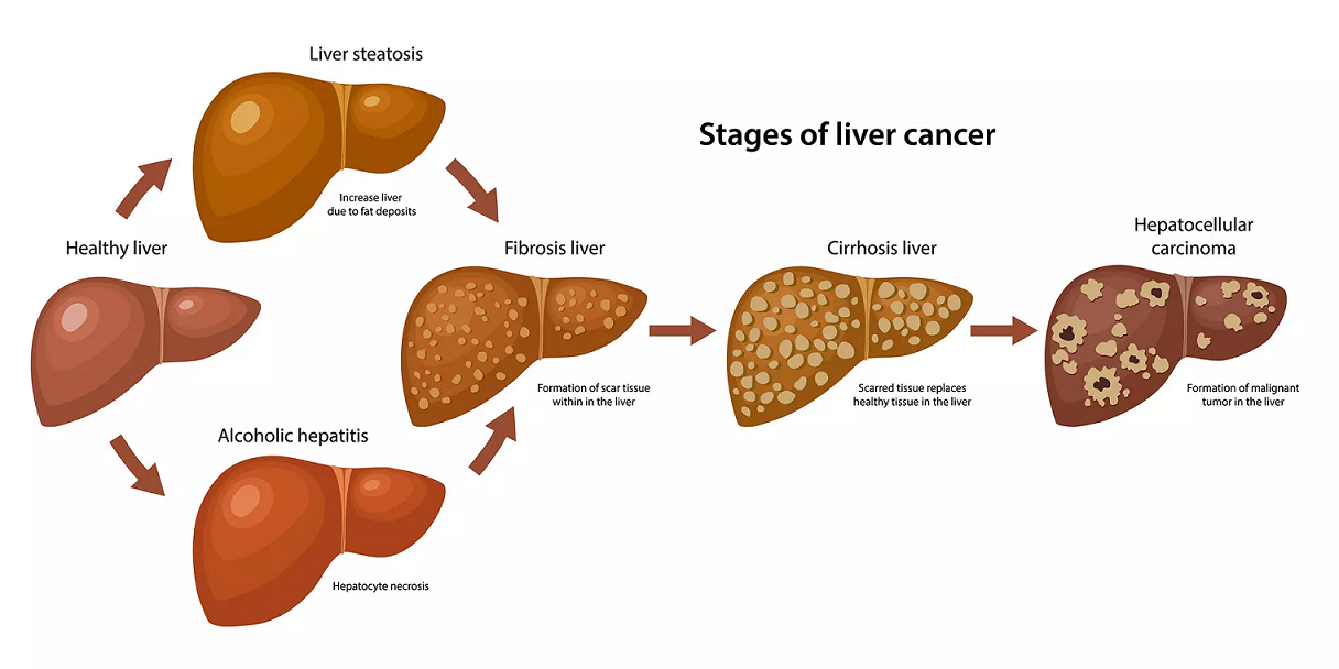 Liver Cancer Diagnosis and Staging